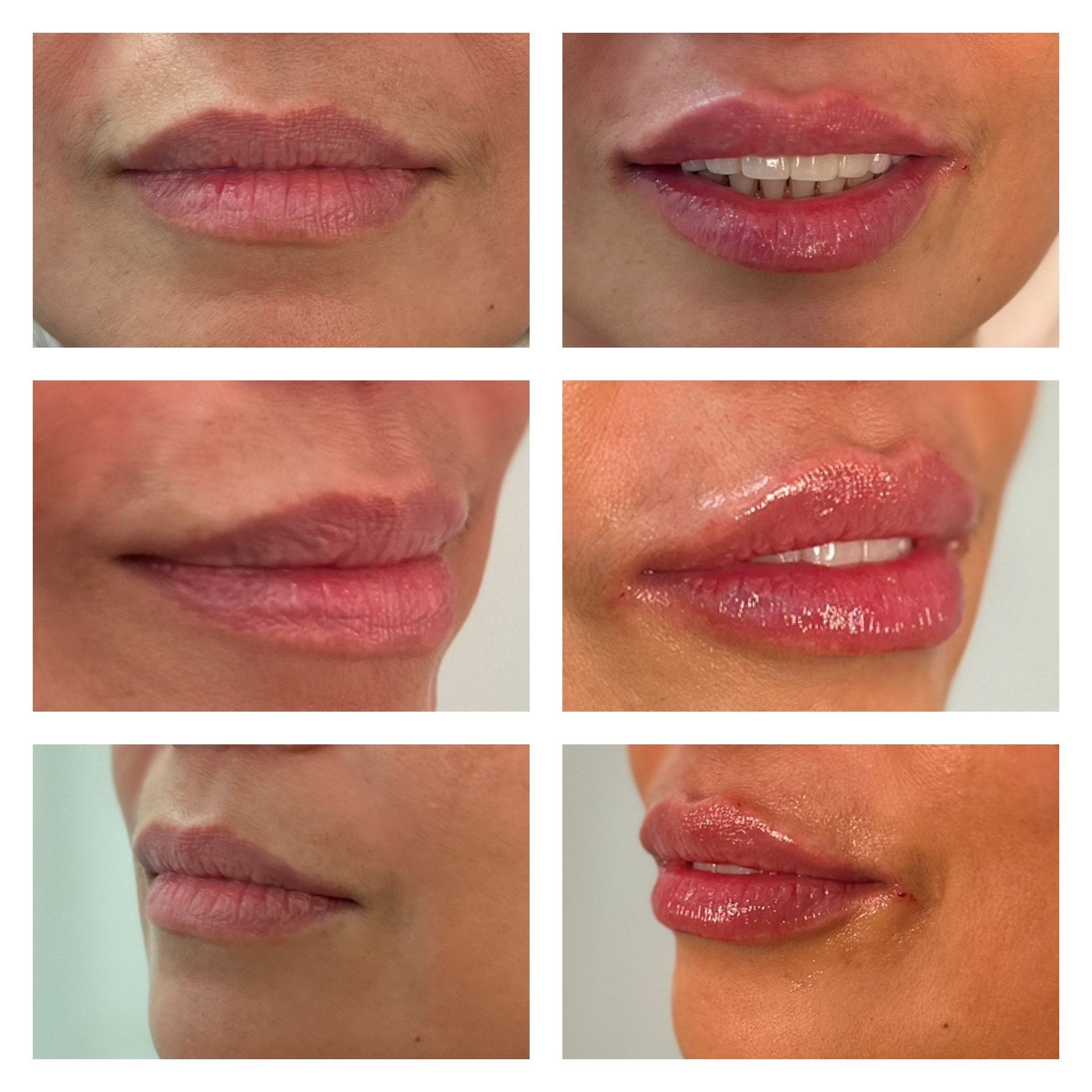 Six lip close-ups: before and after lip filler. Lips are pink, glossy.