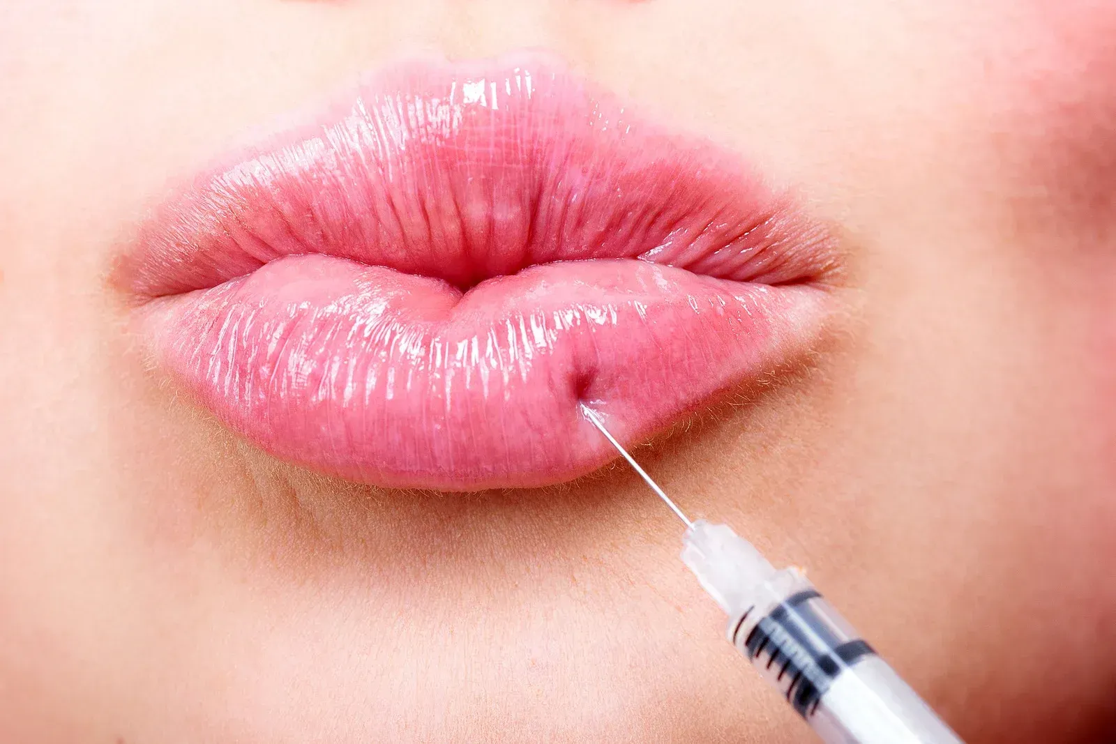 Lip injection procedure in progress; syringe pointed at pink lips.