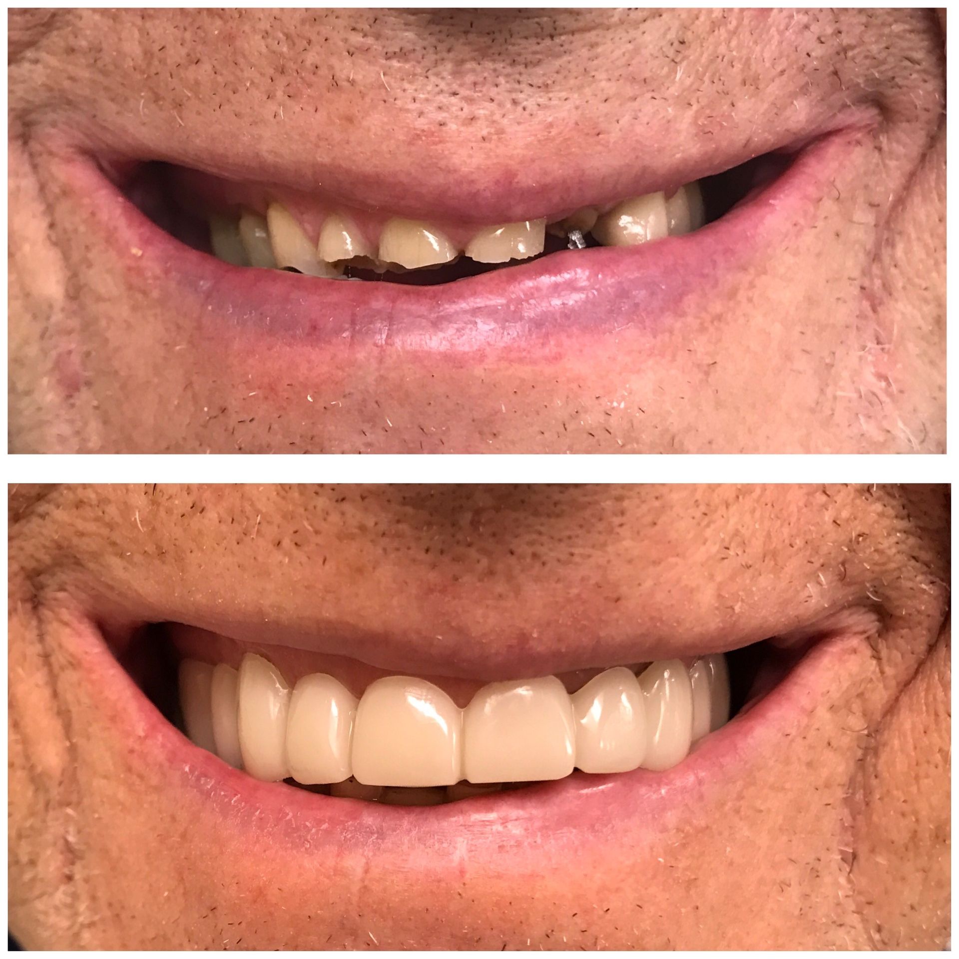 Snap On Smile