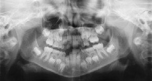 A black and white x-ray of a child 's teeth.