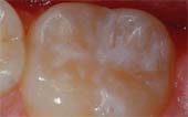A close up of a tooth with a white filling on it.