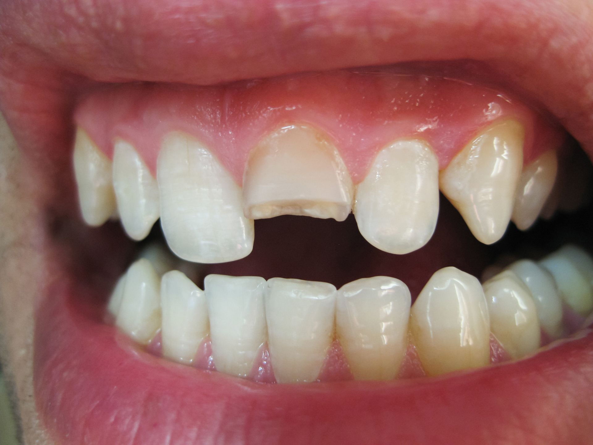 Close-up of a mouth with a missing upper front tooth and visible teeth