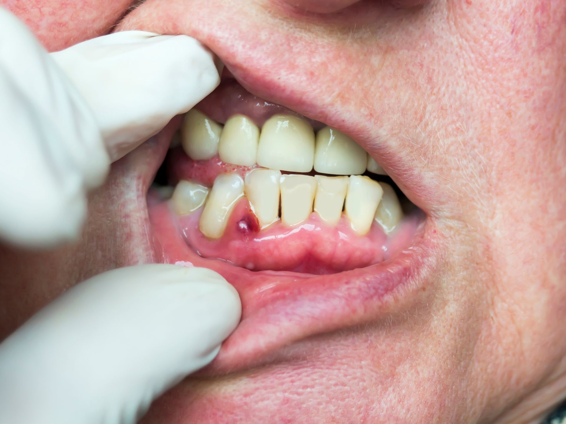 Gloved hand pulling back lip to reveal swollen, bleeding gum near lower front teeth