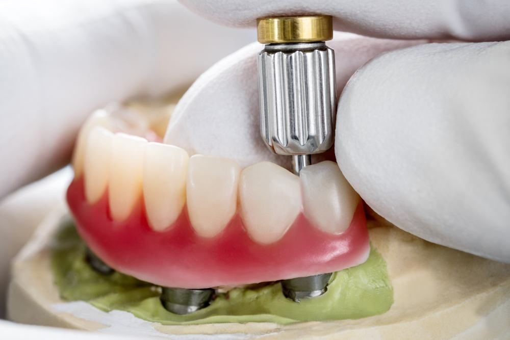 A Dentist Is Installing A Denture On A Model Of A Person 's Teeth — Dental Care Smithfield In Smithfield, QLD