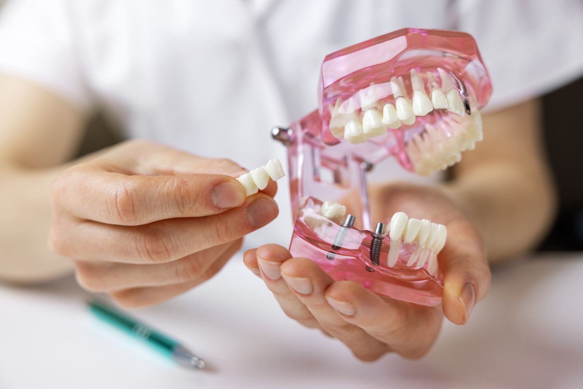 A Dentist Is Holding A Model Of Teeth With Dental Implants — Dental Care Smithfield In Smithfield, QLD