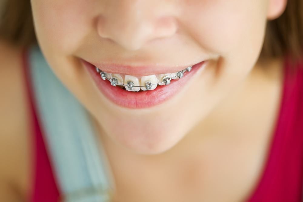 A Young Girl With Braces On Her Teeth Is Smiling — Dental Care Smithfield In Smithfield, QLD