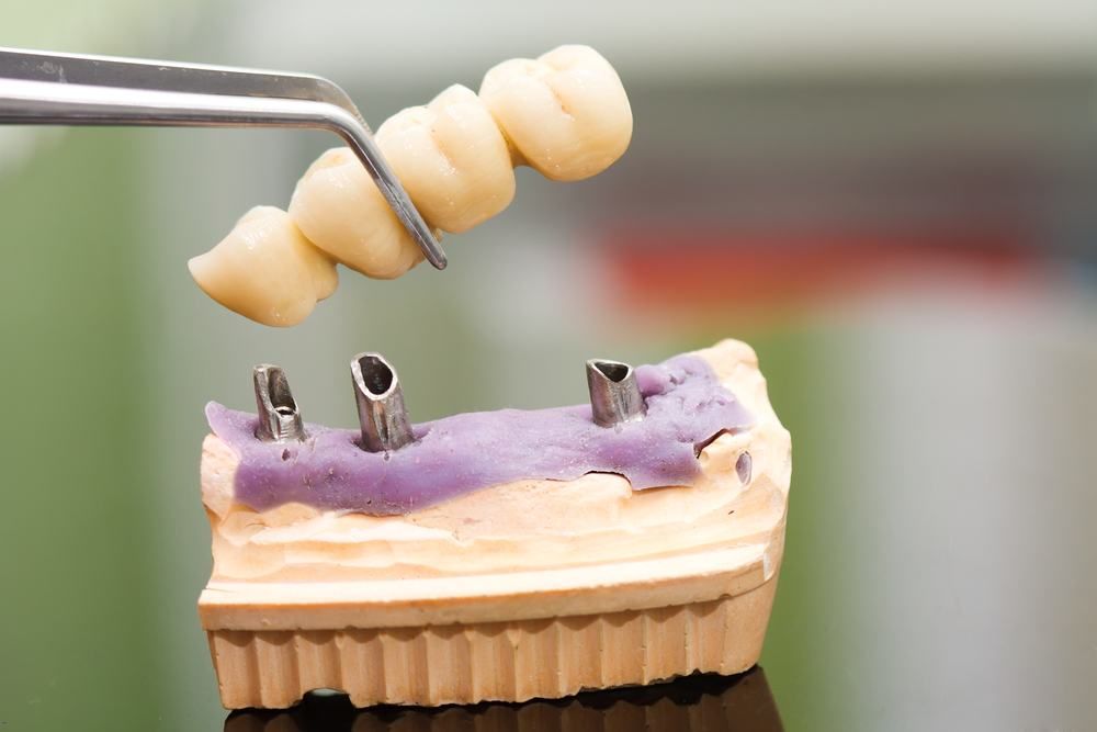 A Dental Bridge Is Being Built On A Model Of A Tooth — Dental Care Smithfield In Smithfield, QLD