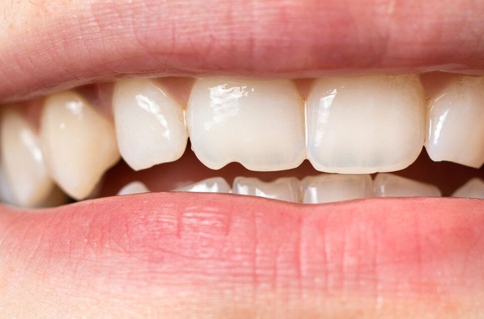 A close up of a man 's mouth with a broken tooth — Dental Care Smithfield In Smithfield, QLD