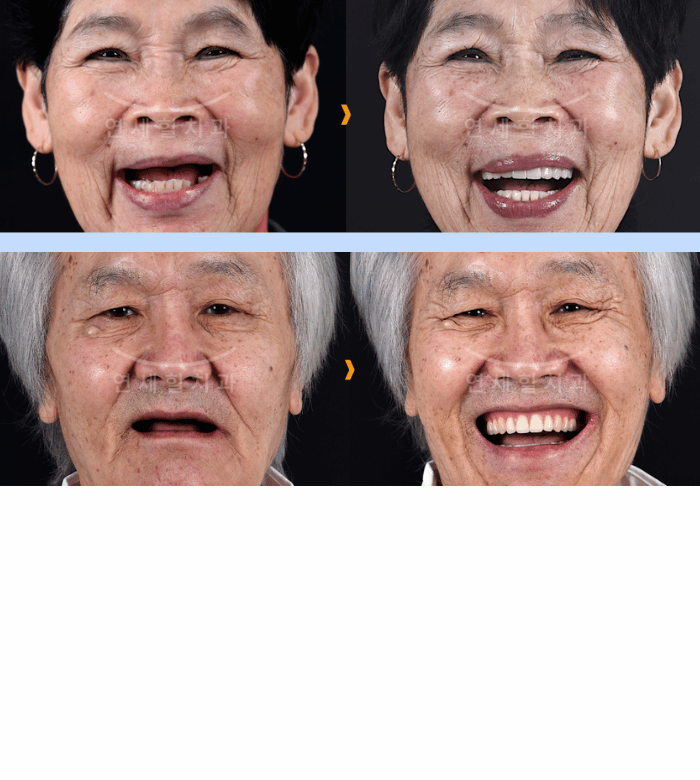 Before and after photos: two elderly people with noticeable dental improvements, smiling broadly after treatment.