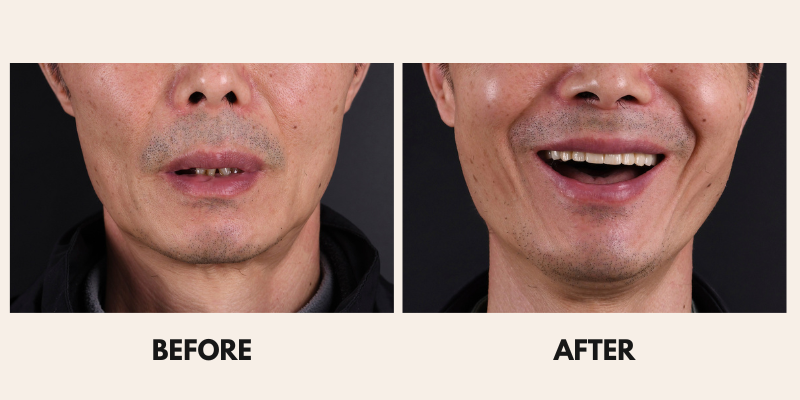 Before and after photos of a man's smile, highlighting teeth replacement. He's smiling widely in the