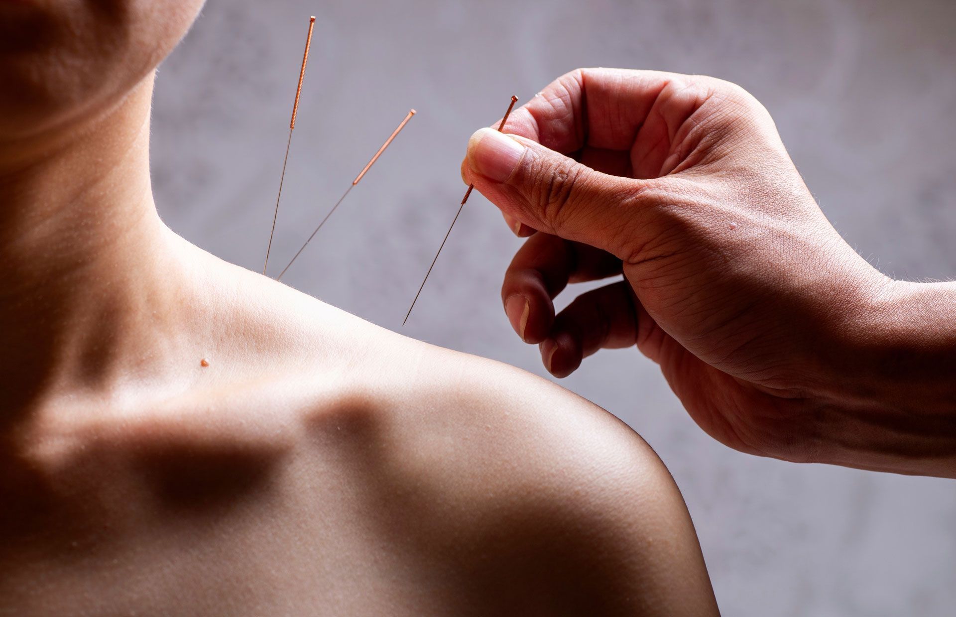 A person is getting acupuncture on their shoulder.