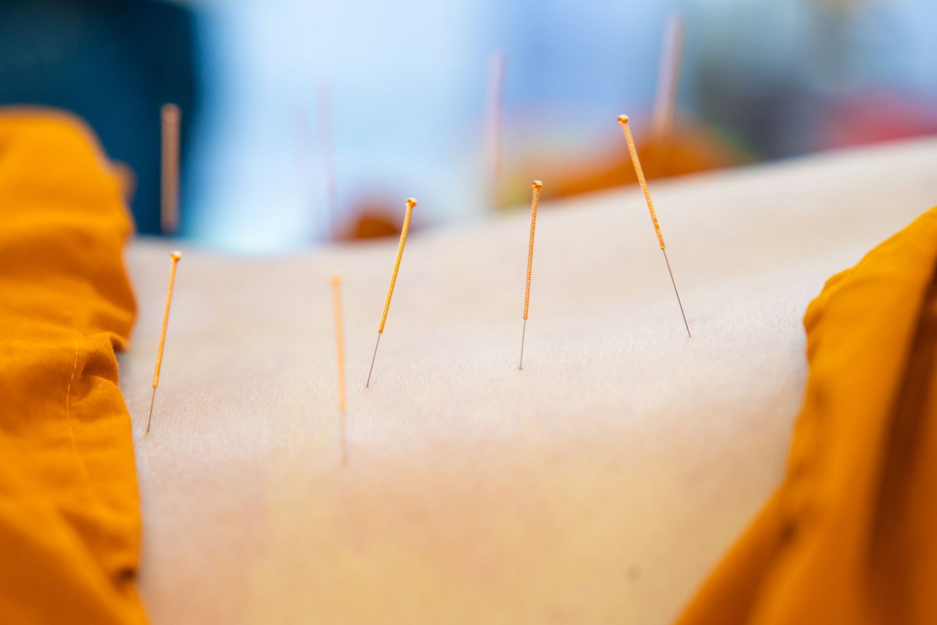 A person is getting acupuncture on their back.