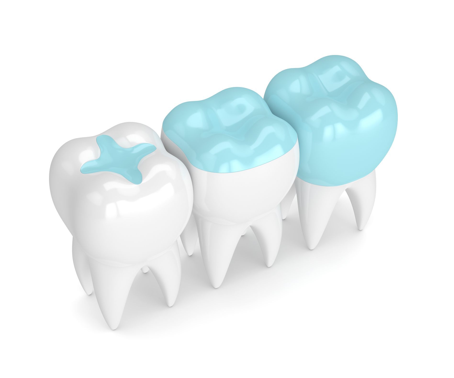 A row of teeth with fillings on them on a white background.