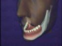 Jaw With Teeth — Kennebunk, ME — Denture Solutions