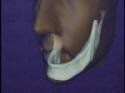 Jaw Immediate After Tooth Extraction — Kennebunk, ME — Denture Solutions