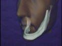 Jawbone After Ten Years — Kennebunk, ME — Denture Solutions