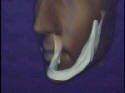 Jawbone After Five Years — Kennebunk, ME — Denture Solutions