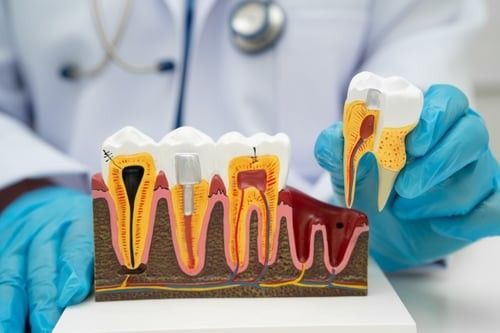 Early Signs of Tooth Decay You Shouldn’t Ignore