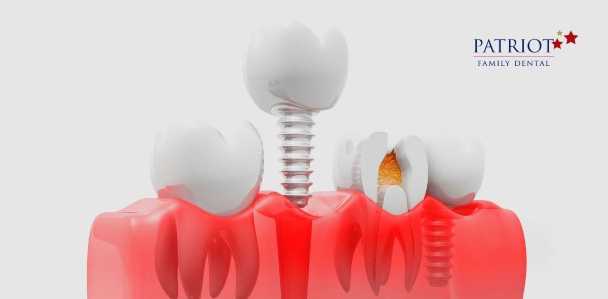 mini dental implants - clarksville, TN