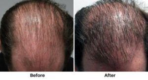 Before-and-after comparison of a balding scalp, showing increased hair coverage on the right.