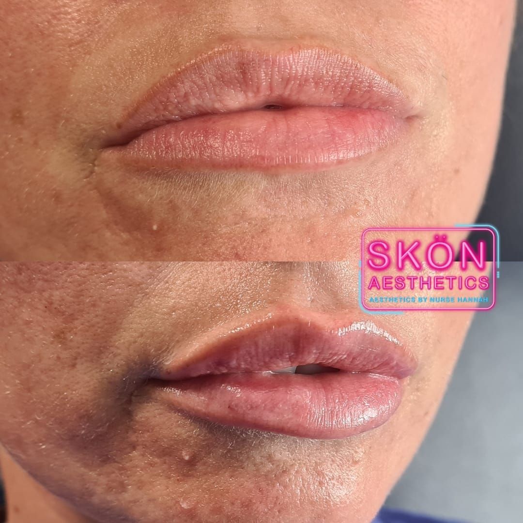 Rep Lips Lip Filler Injections Leeds | Skön Aesthetics