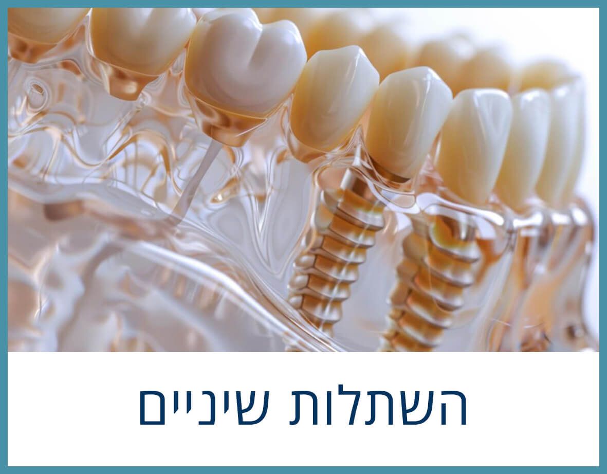 מודל שתלים דנטליים, שיניים לבנות על ברגים בצבע זהב. טקסט בעברית: