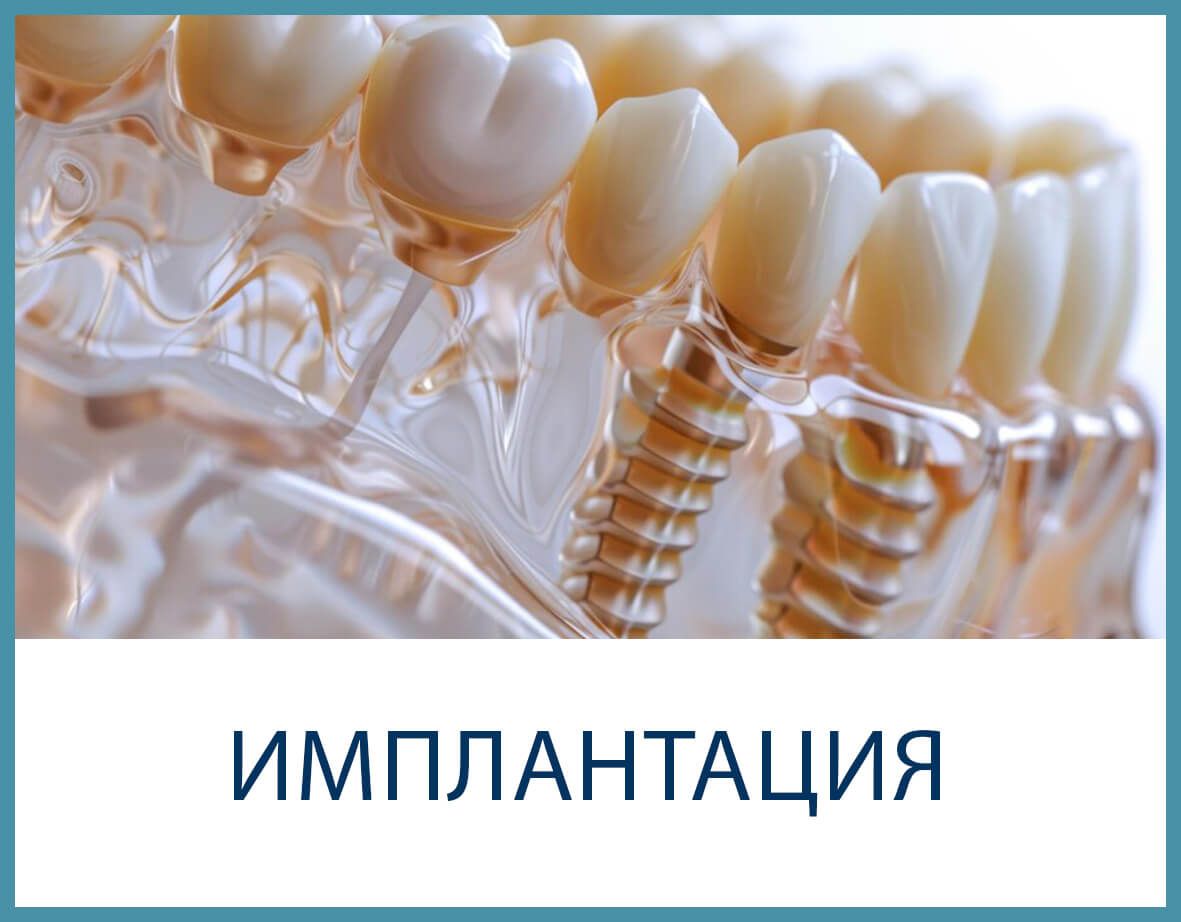 Зубные импланты и коронки; надпись «ИМПЛАНТАЦИЯ» на белом фоне.