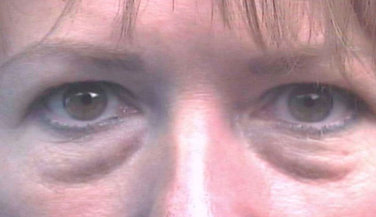 Facial Surgery