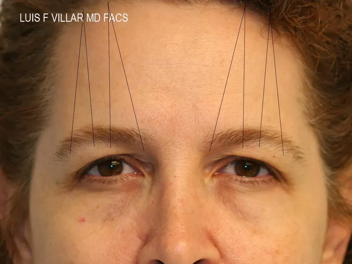 Facial Surgery
