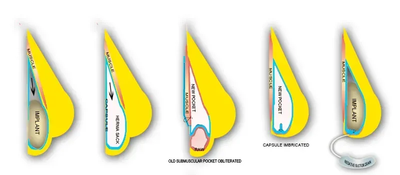 Breast Surgery