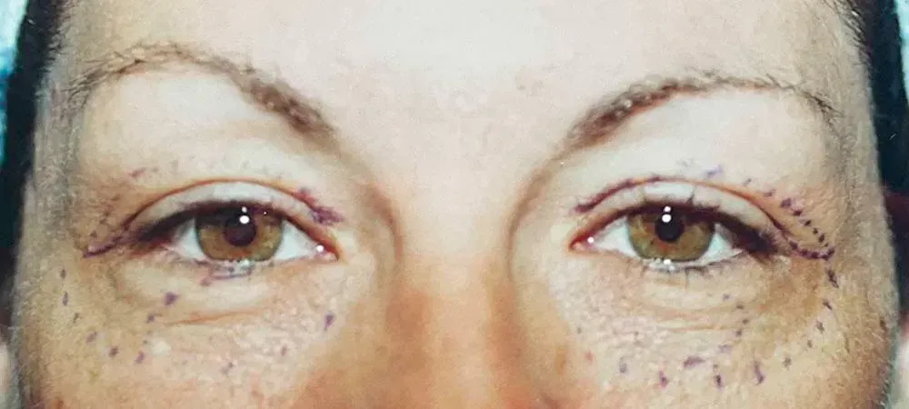Facial Surgery