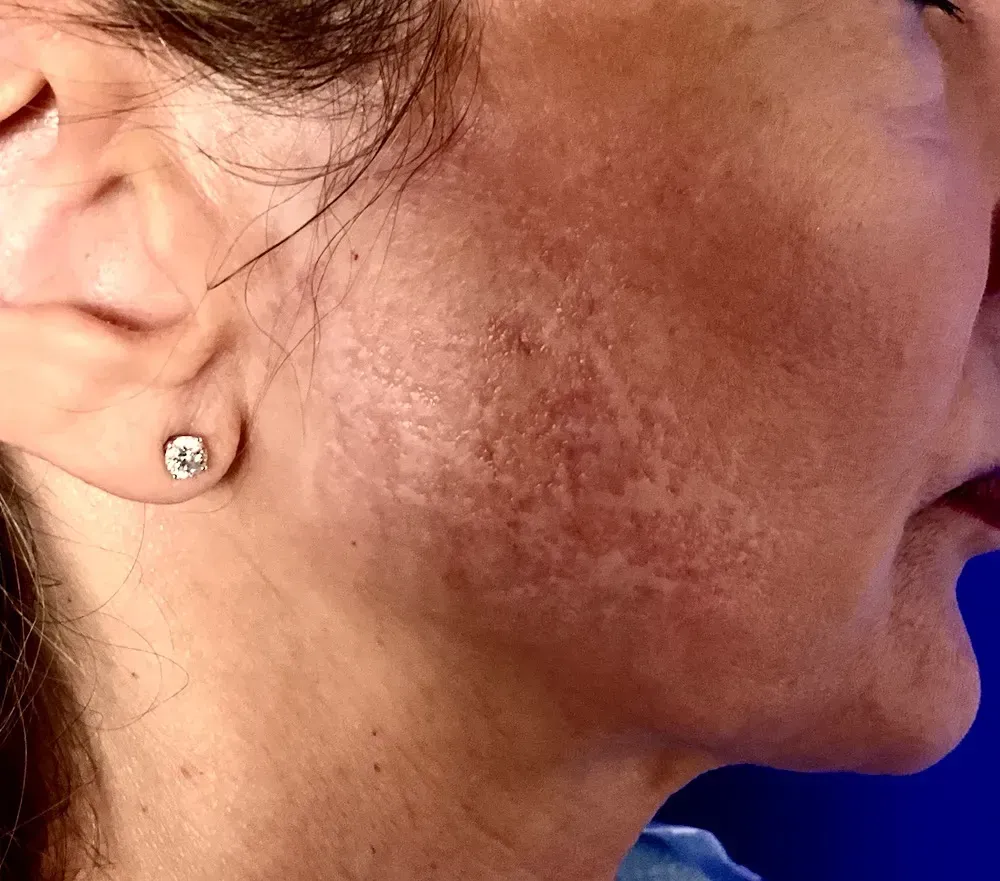 Facial Surgery