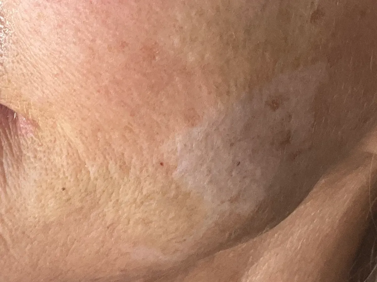 botox near me