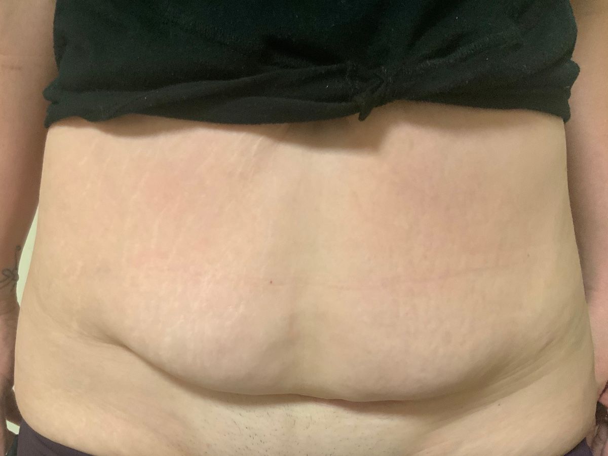 abdominoplasty cost