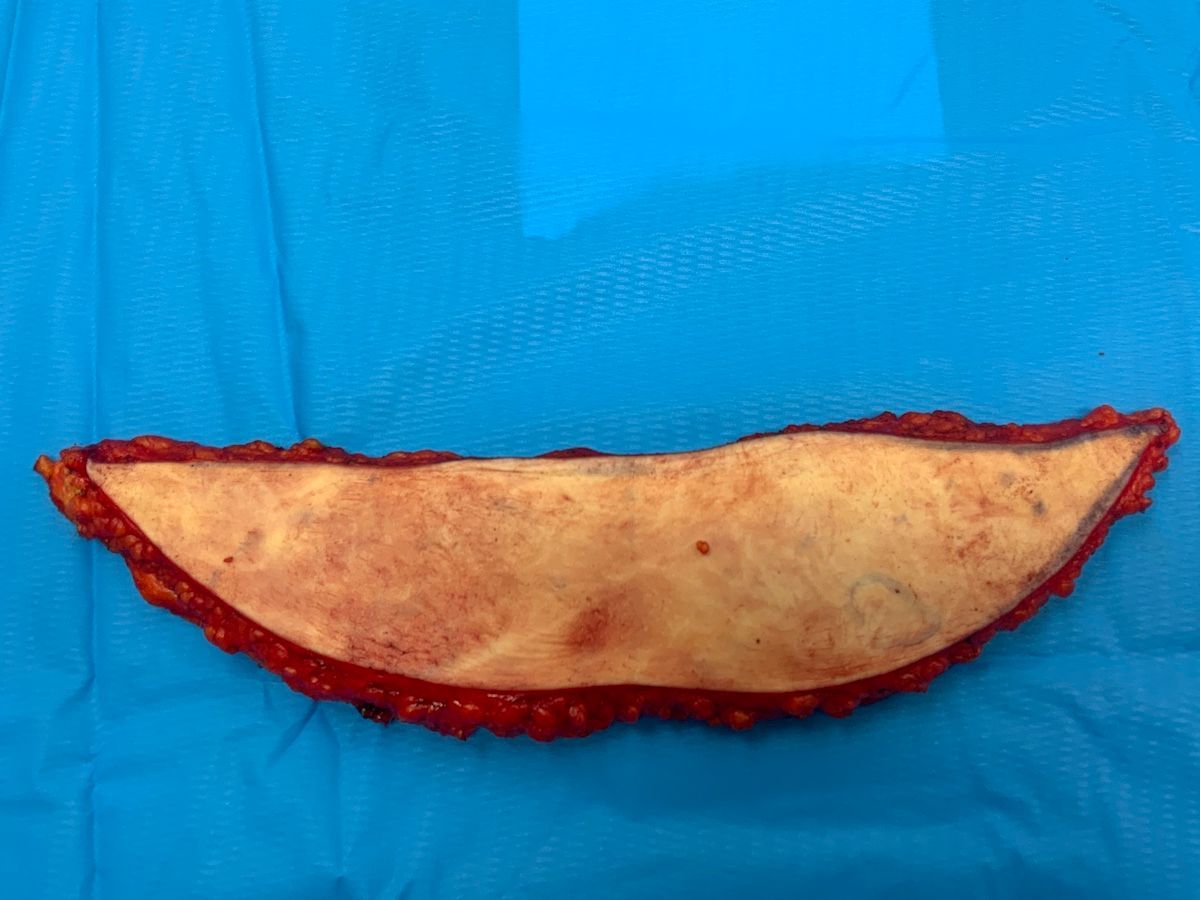 abdominoplasty cost