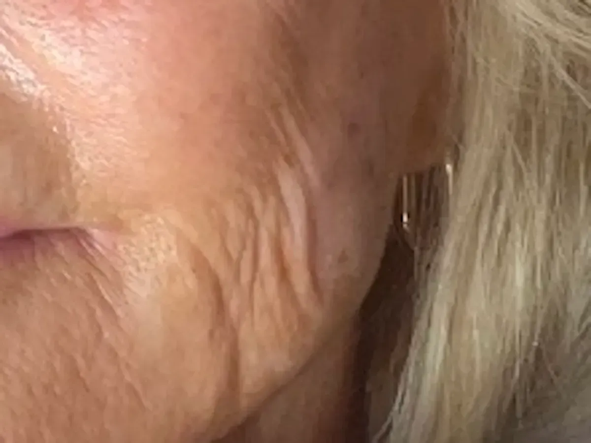botox near me