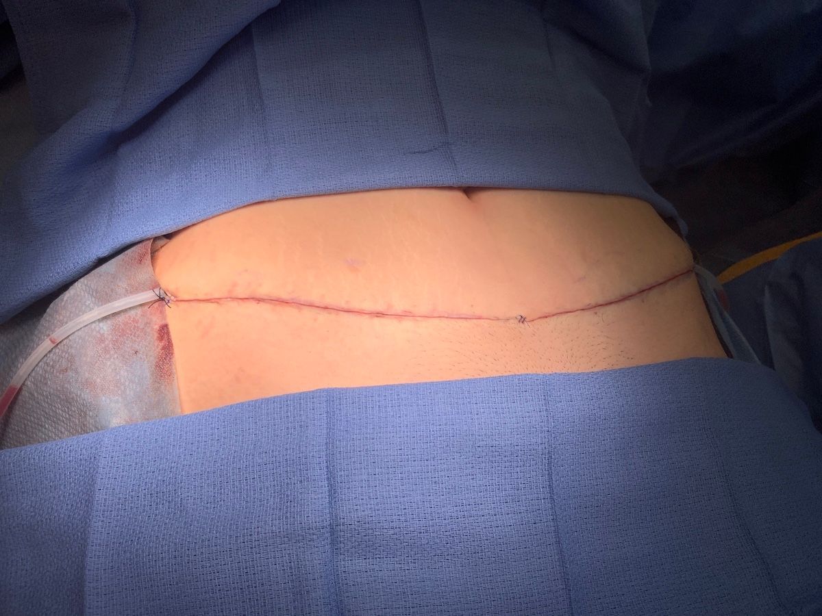 abdominoplasty cost