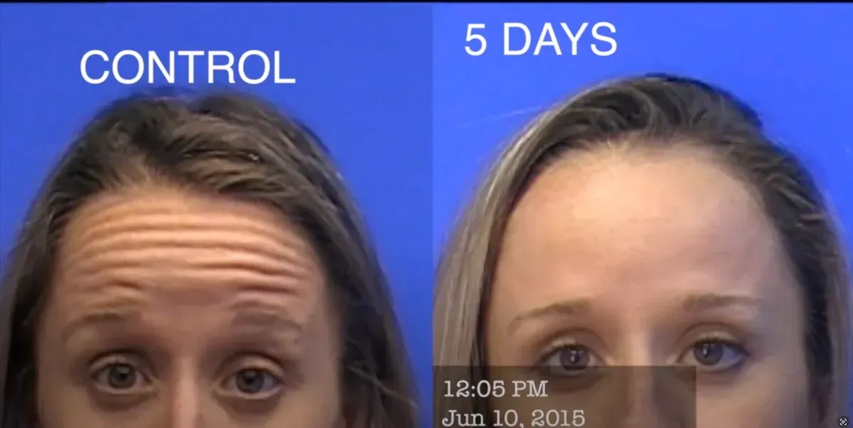 botox near me