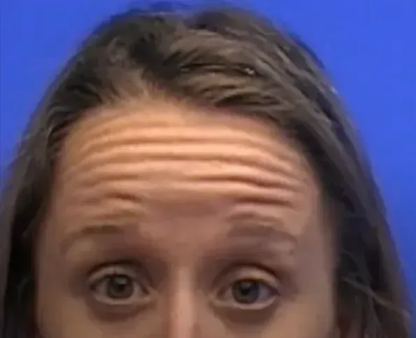 botox near me