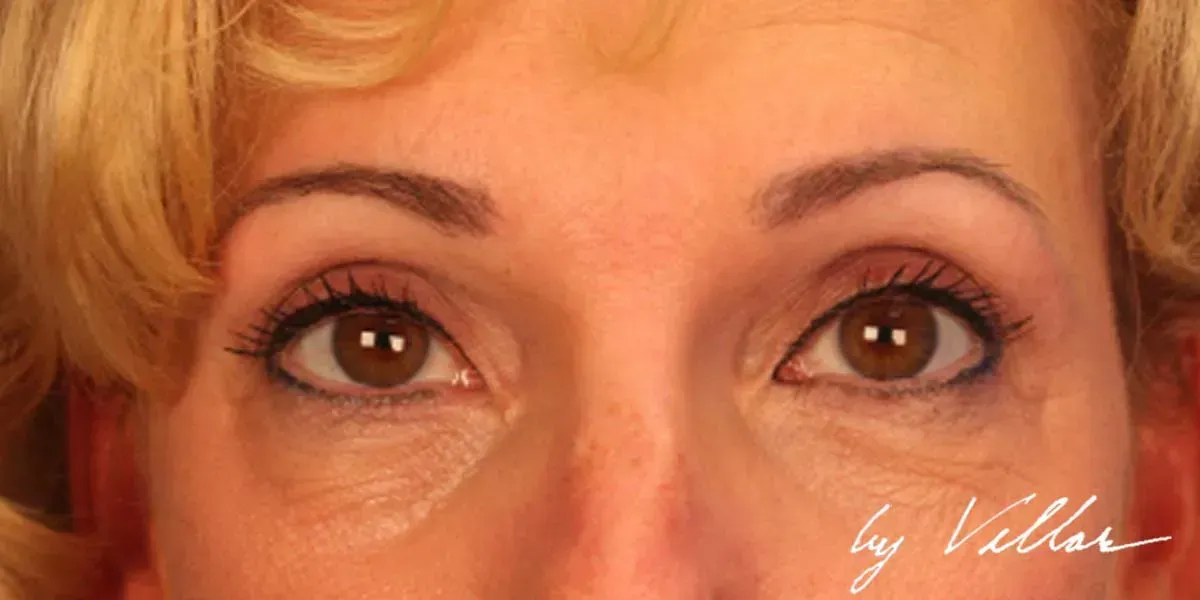 Facial Surgery