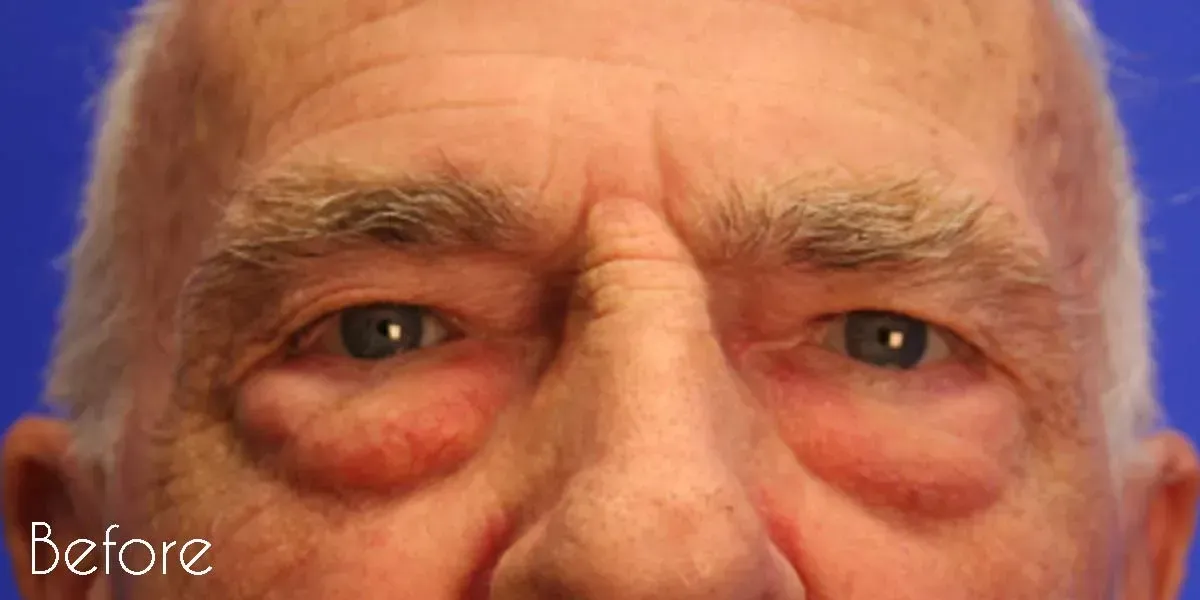 Facial Surgery