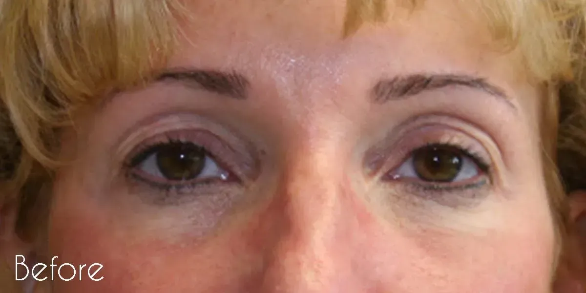 Facial Surgery