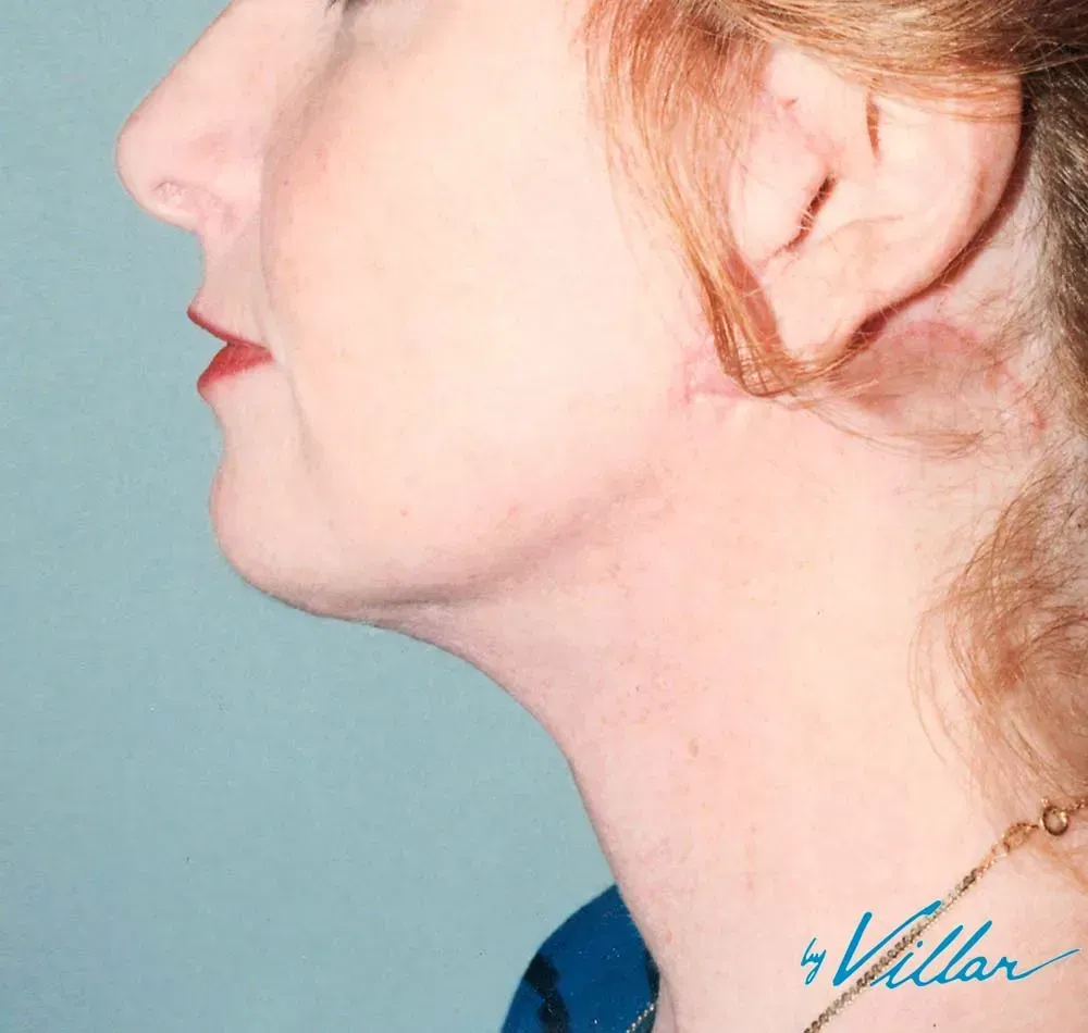 Facial Surgery