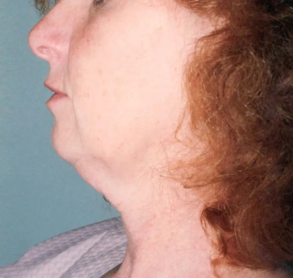 Facial Surgery