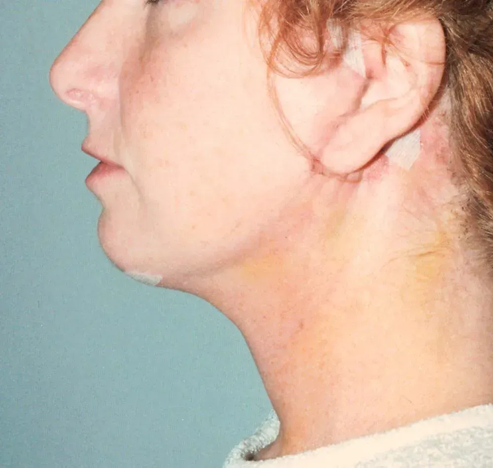 Facial Surgery