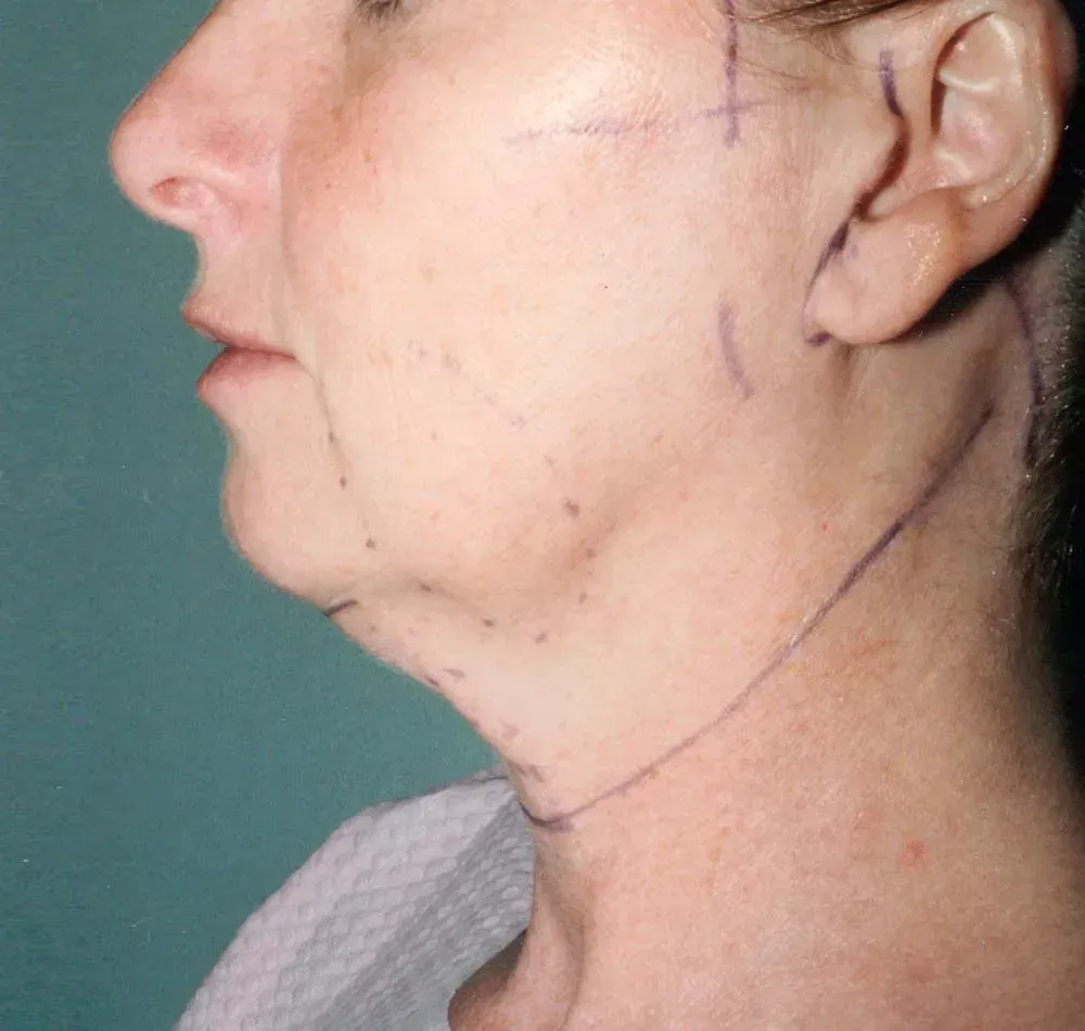 Facial Surgery