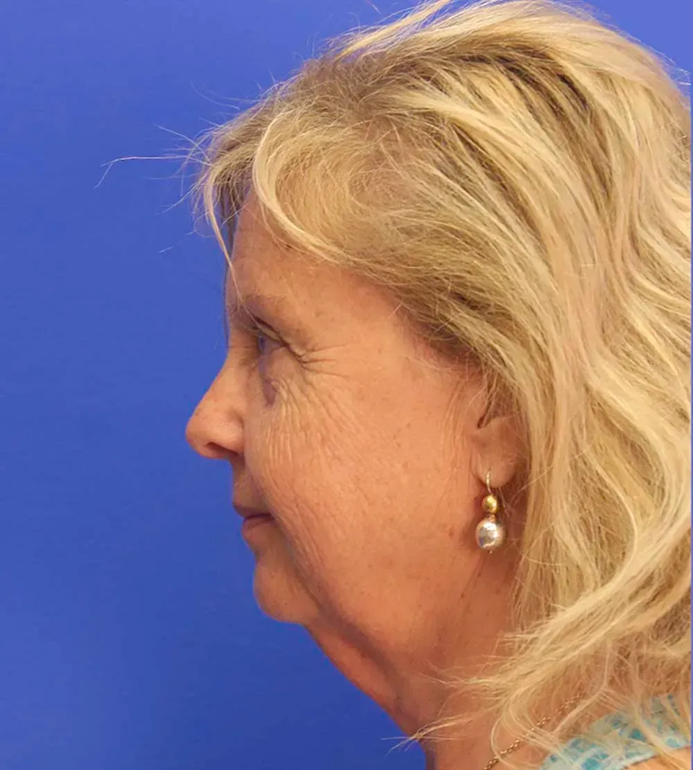Facial Surgery
