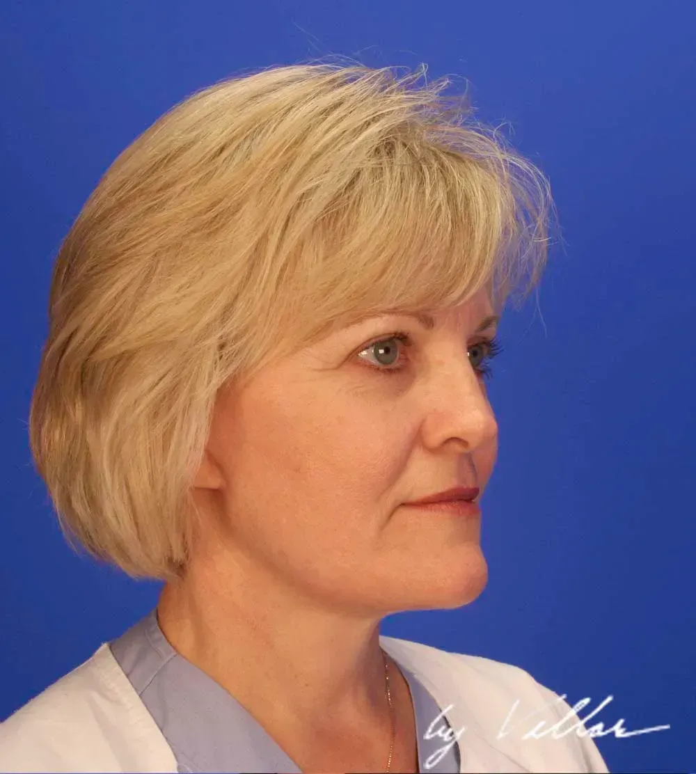 Facial Surgery