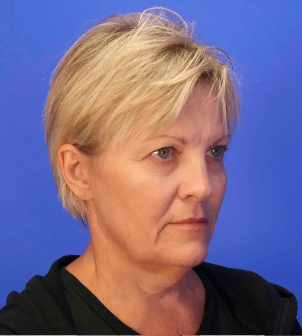 Facial Surgery