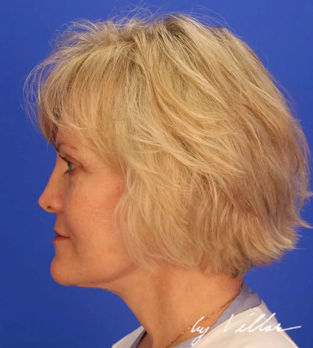 Facial Surgery